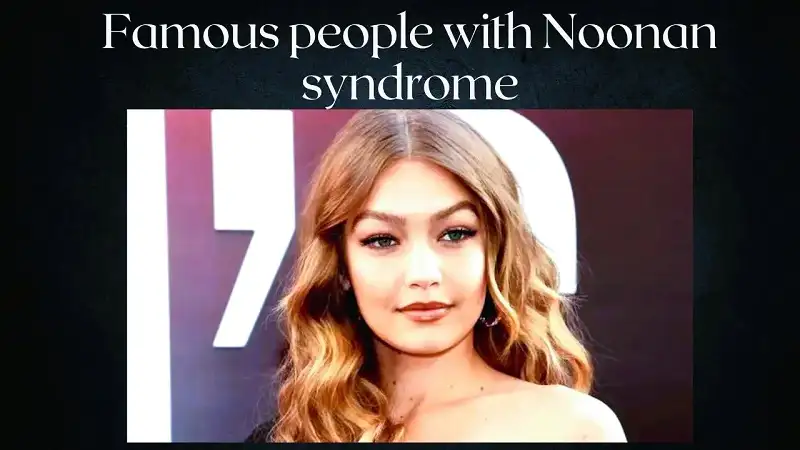 Famous People With Noonan Syndrome